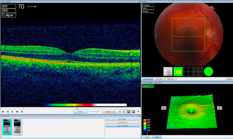 DeepMind's algorithm analysing an OCT eye scan
