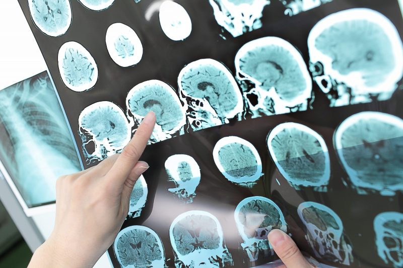 strokes CT scan brain blood clots